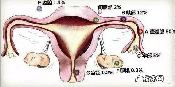 宫外孕能变成宫内孕吗?