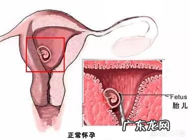 宫外孕能变成宫内孕吗？