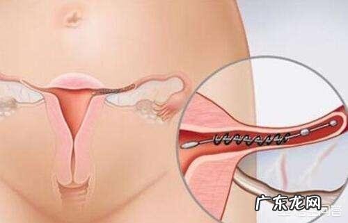 宫外孕能变成宫内孕吗？