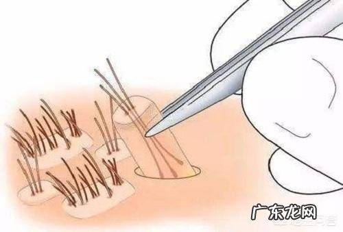 脂溢性脱发用生姜洗头有效果吗?有什么副作用?