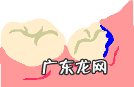 智齿冠周炎自己怎么处理 智齿冠周炎是怎么引起的