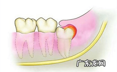 智齿冠周炎自己怎么处理 智齿冠周炎是怎么引起的