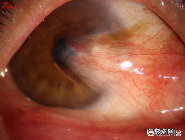 日常生活中，如何进行眼部保养？