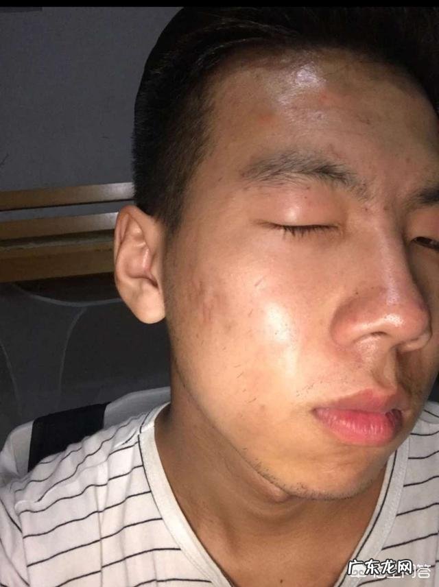 中药祛痘可以吗?效果怎么样?