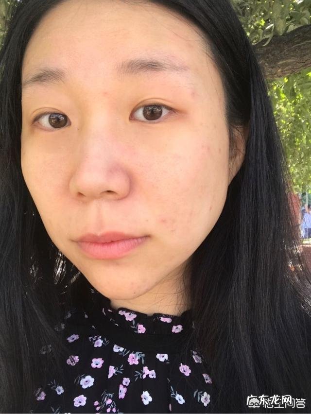 中药祛痘可以吗?效果怎么样?