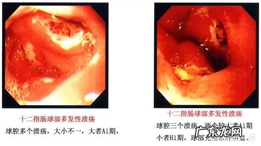 什么是慢性胃炎,胃炎分几种?