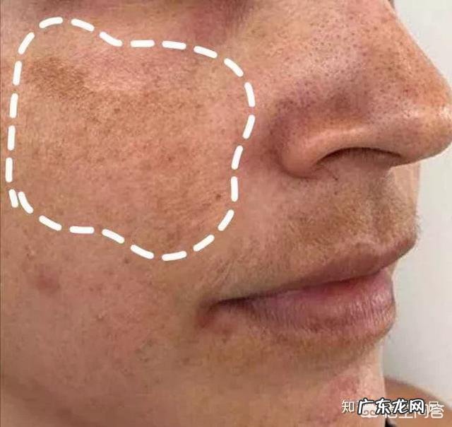 黄褐斑、雀斑、老年斑、颧骨褐青痣发生形成的原因是什么?