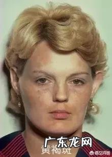 黄褐斑、雀斑、老年斑、颧骨褐青痣发生形成的原因是什么?