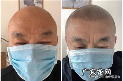 为什么网上说大家千万不要植发?