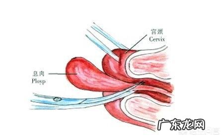 宫颈炎的成因都有什么?