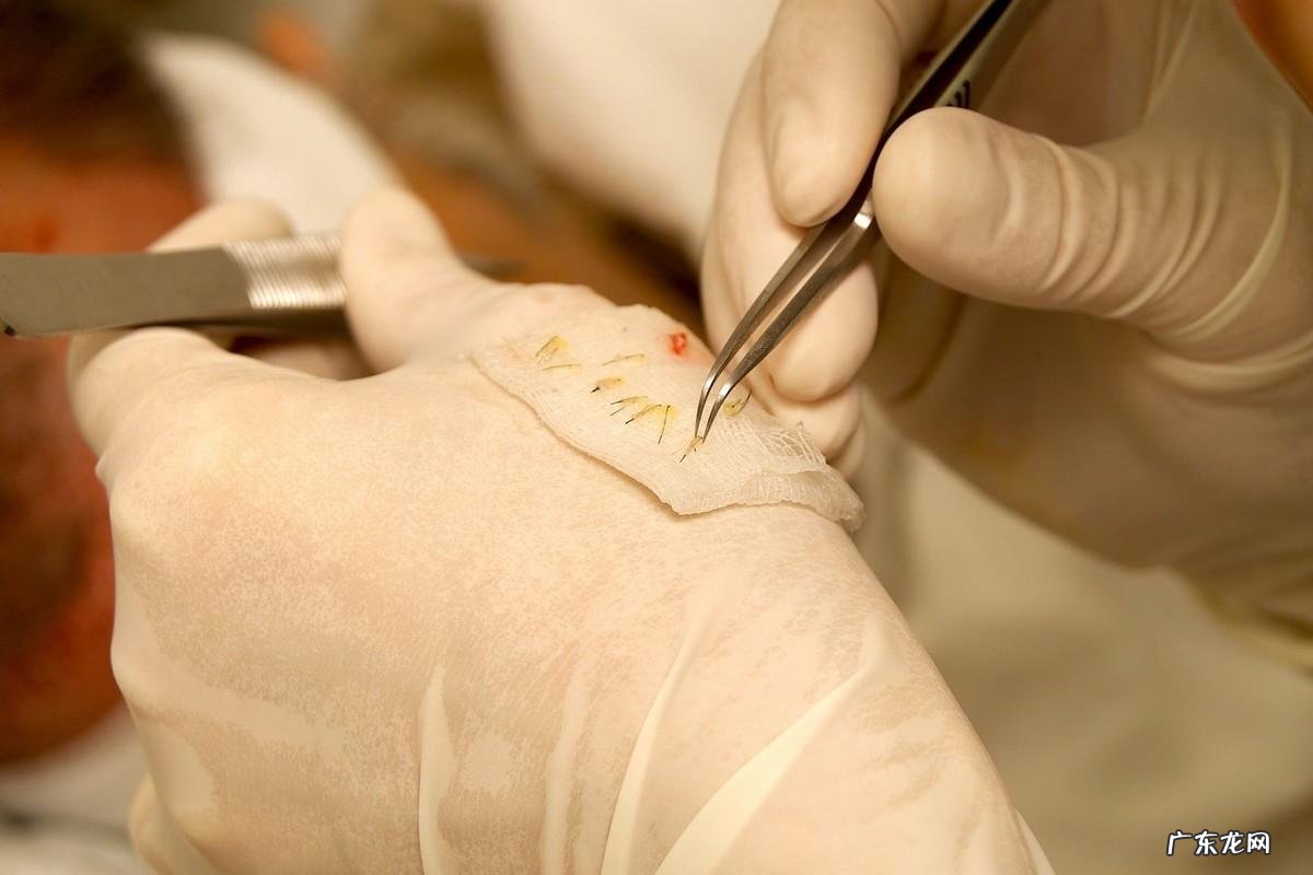 脱发怎么治疗最好生发秘方 脱发治疗方法