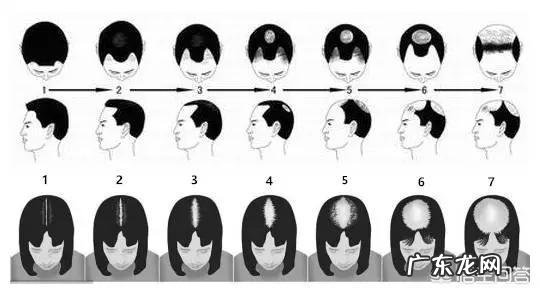 女的掉头发特别厉害是什么原因？应该注意什么问题？