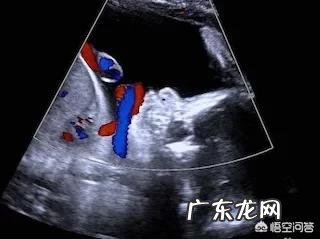 胎儿出现脐带绕颈,跟孕妇睡觉姿势有关吗?