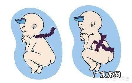 胎儿出现脐带绕颈,跟孕妇睡觉姿势有关吗?