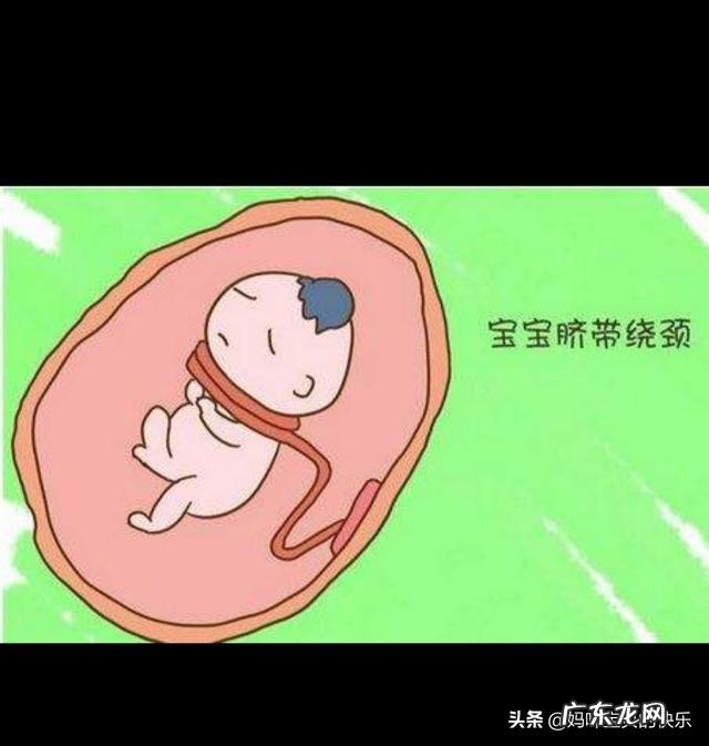 胎儿出现脐带绕颈,跟孕妇睡觉姿势有关吗?