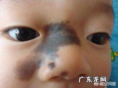 胎记的形成原因,如何才能消除它?