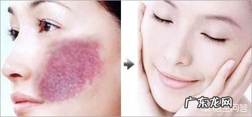 胎记的形成原因,如何才能消除它?