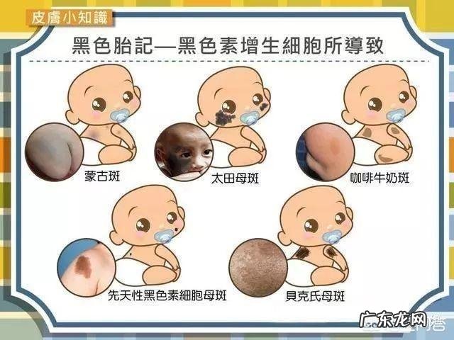 胎记的形成原因,如何才能消除它?