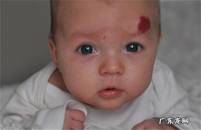 胎记的形成原因,如何才能消除它?