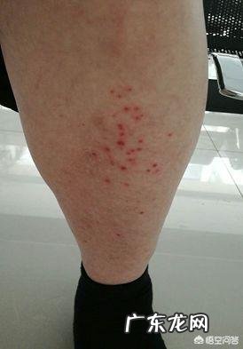 手足口病是一种儿童病吗,大人会不会得这个病?该如何防治呢?