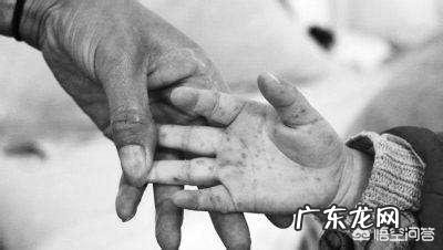 手足口病是一种儿童病吗,大人会不会得这个病?该如何防治呢?