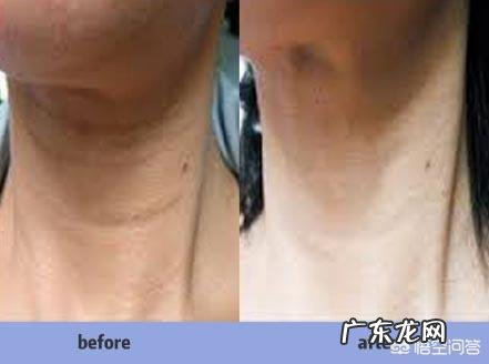 有什么最有效的方法去掉颈纹?