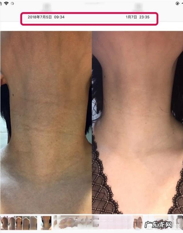 有什么最有效的方法去掉颈纹?