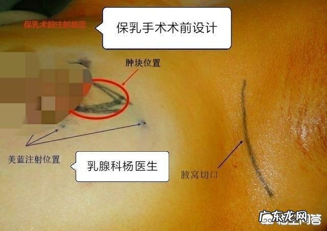 乳腺癌患者割除乳腺后复发癌变的几率大吗?
