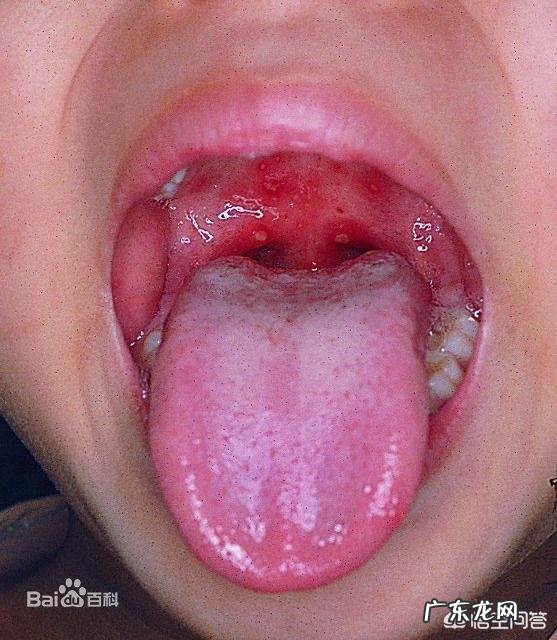 哪些因素导致小儿鹅口疮?