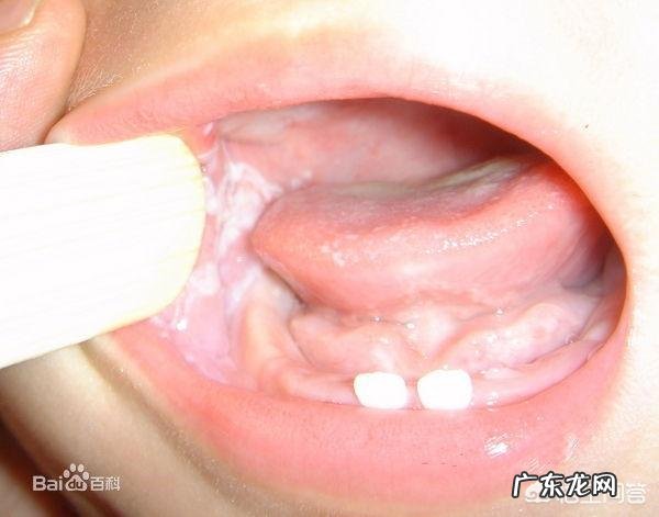 哪些因素导致小儿鹅口疮?