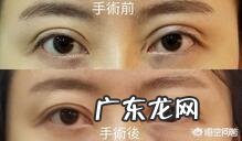 双眼皮能修复几次?