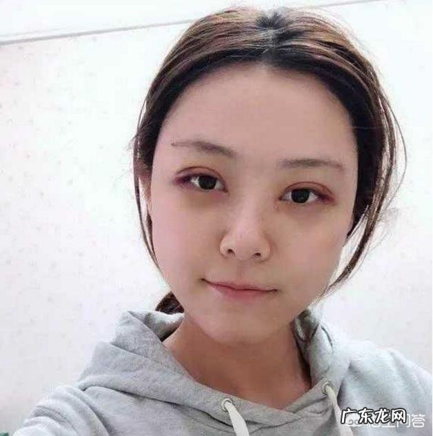 双眼皮能修复几次?