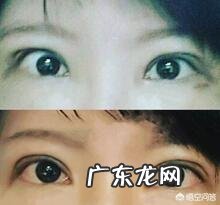 双眼皮能修复几次?