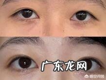 双眼皮能修复几次?