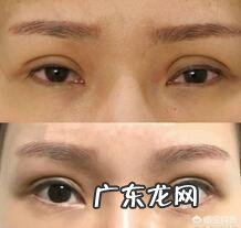 双眼皮能修复几次?