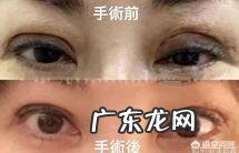 双眼皮能修复几次?