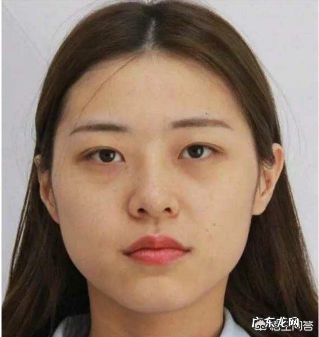 双眼皮能修复几次?