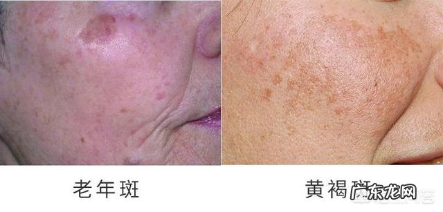 祛除老年斑最有效的方法是什么?