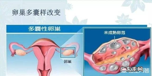 多囊卵巢综合征是什么?