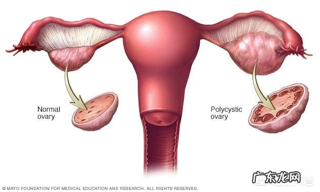 多囊卵巢综合征是什么?