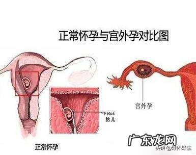 做试管婴儿如何避免宫外孕的发生？