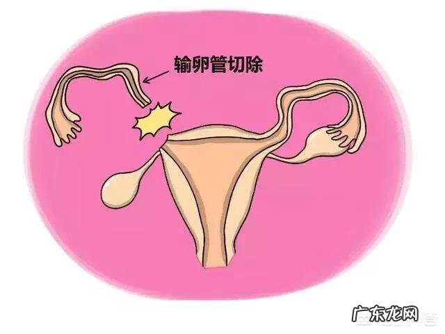 做试管婴儿如何避免宫外孕的发生?