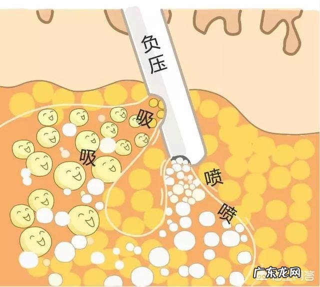 哪些动作坚持下来可以瘦小腿?