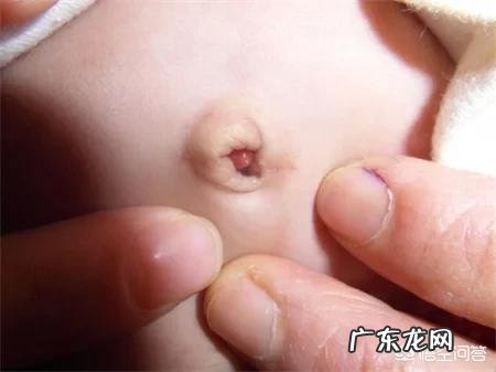 新生儿宝宝的脐部如何进行护理？