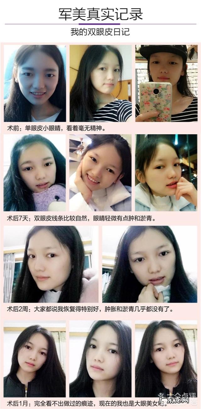 你们觉得埋线双眼皮怎么样?