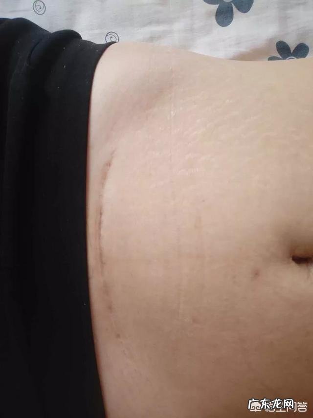 剖腹产坐月子要多长时间?月子期间需要注意哪些事项?