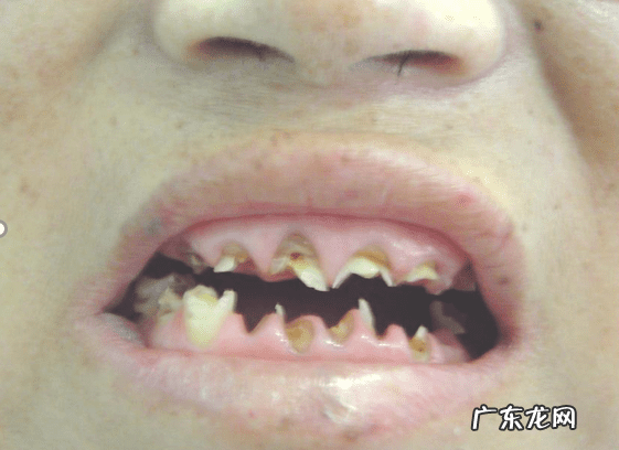 哪些人会得干燥综合症 干燥综合症的症状是什么