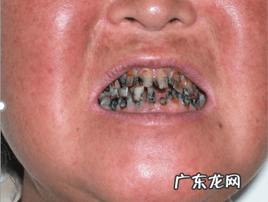 哪些人会得干燥综合症 干燥综合症的症状是什么