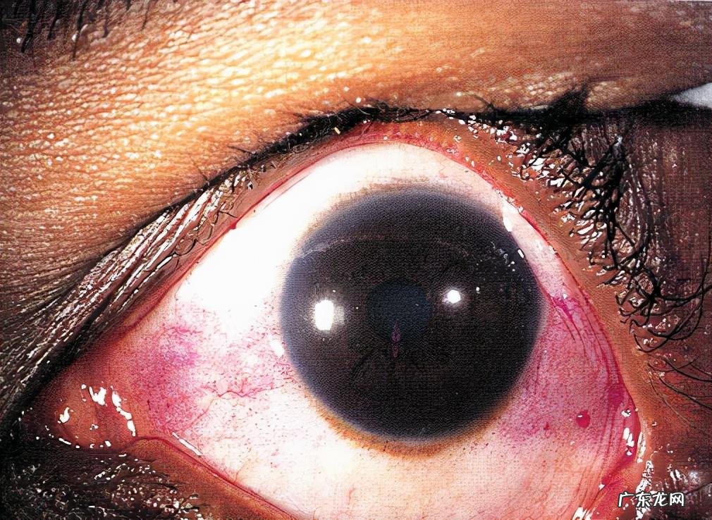 哪些人会得干燥综合症 干燥综合症的症状是什么