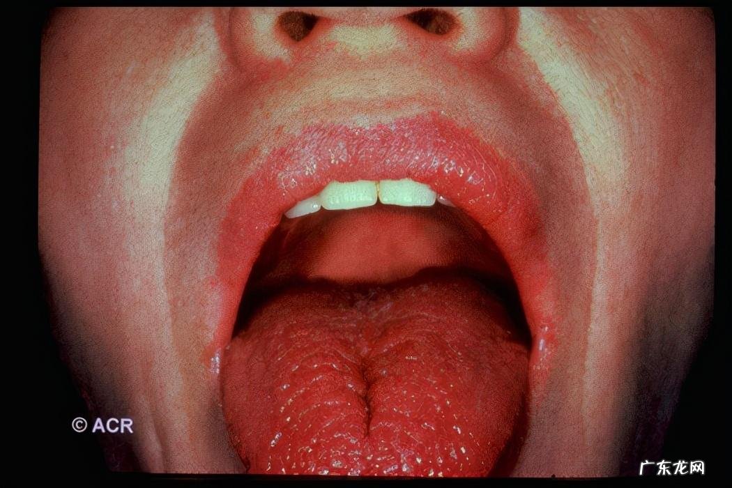 哪些人会得干燥综合症 干燥综合症的症状是什么